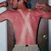 sunburn, bekas matahari, kelamaan berjemur, luka bakar kulit