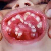 hyperdontia, kelainan gigi, kelainan pada gigi