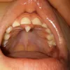 hyperdontia, kelainan gigi, kelainan pada gigi