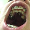hyperdontia, kelainan gigi, kelainan pada gigi