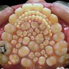 hyperdontia, kelainan gigi, kelainan pada gigi