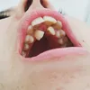 hyperdontia, kelainan gigi, kelainan pada gigi