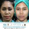 seleb tanam benang, perawatan seleb