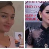 seleb tanam benang, perawatan seleb