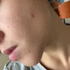 Nikita Willy berjerawat
