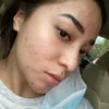 Nikita Willy berjerawat