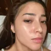 Nikita Willy berjerawat