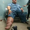 rony dozer kaki bengkak
