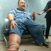 rony dozer kaki bengkak