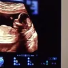 Kylie Jenner\&#039;s Baby Bump
