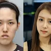 Foto Operasi Plastik Korea