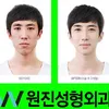 Foto Operasi Plastik Korea