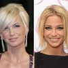 Artis Hollywood Operasi Plastik