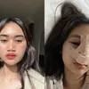 Potret Permesta Dhyaz Anak Farida Nurhan Sebelum dan Sesudah Oplas Hidung di Thailand