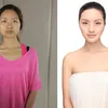 foto-foto operasi plastik di China