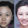 foto-foto operasi plastik di China