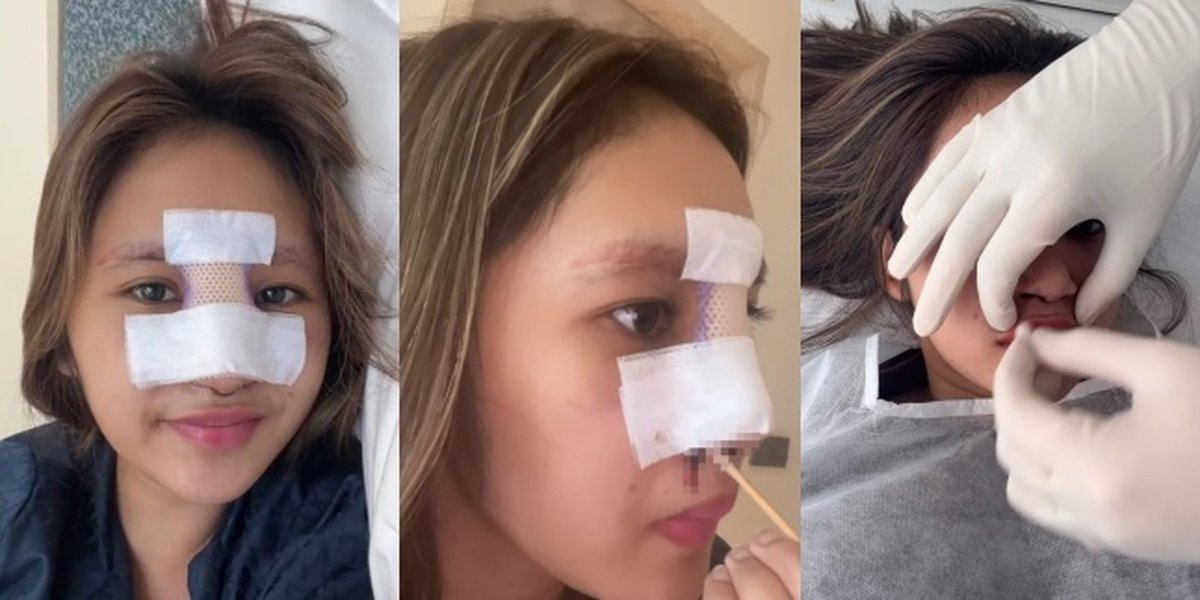 11 Pictures of Permesta Dhyaz's Condition, Farida Nurhan's Daughter, After Nose Implant Removal Surgery, Cleaning Blood Clots from the Nose Causes Pain
