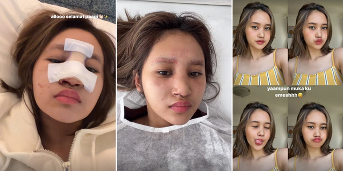 15 Latest Photos of Permesta Dhyaz's Condition After Infection Due to Plastic Surgery, Bandage Has Been Removed - Realize Her Nose is Back to Being Flat