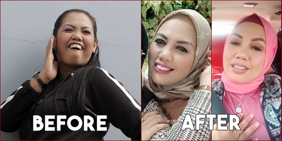 8 Photos of Elly Sugigi Before and After Teeth Cutting