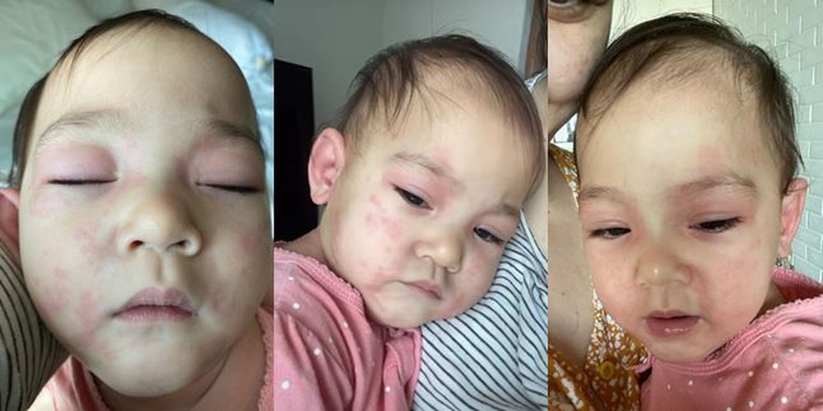 9 Photos of Baby Numa, Mona Ratuliu's Child, Experiencing Food Allergy, Red Spots Appearing All Over the Body - Swollen Eyes and Ears