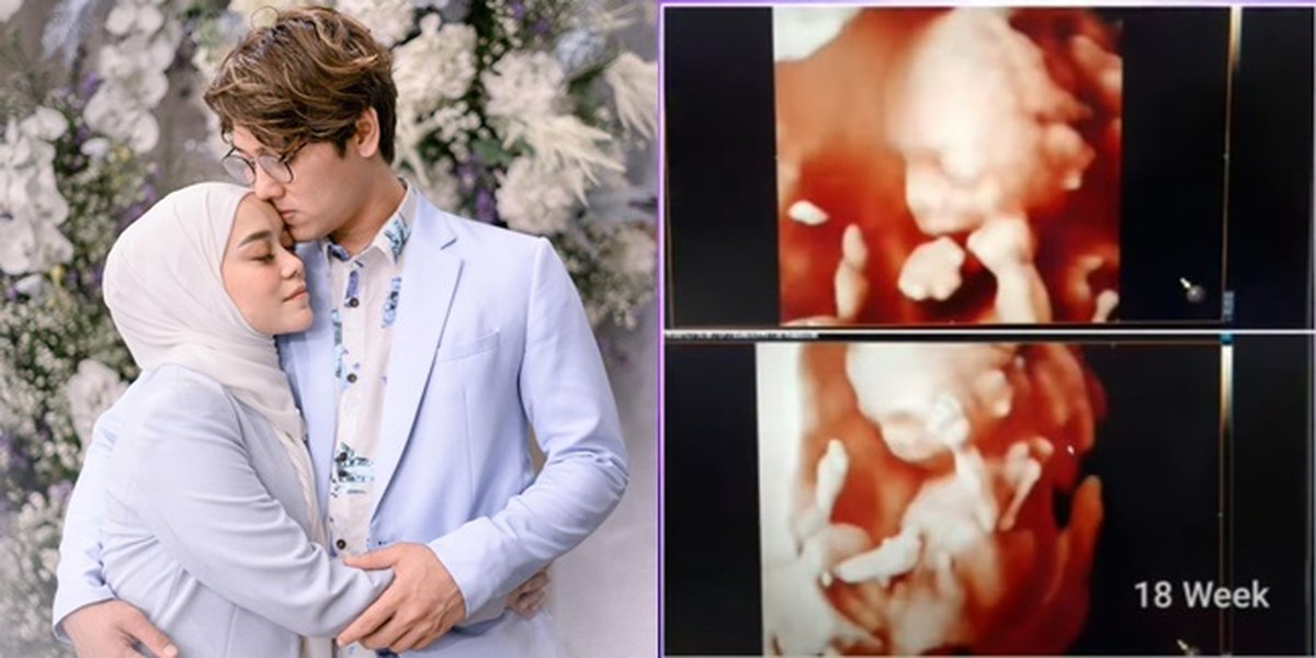 9 Photos of Lesti and Rizky Billar's Ultrasound Revealed, Leslar Junior's Face Resembles Their Mother