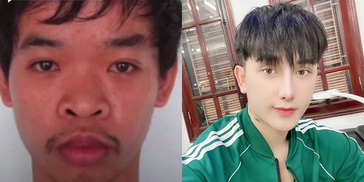 Drastic Change, Here are 8 Photos of Do Quyen, a Vietnamese Man who Underwent Plastic Surgery After Being Laughed at During a Job Interview