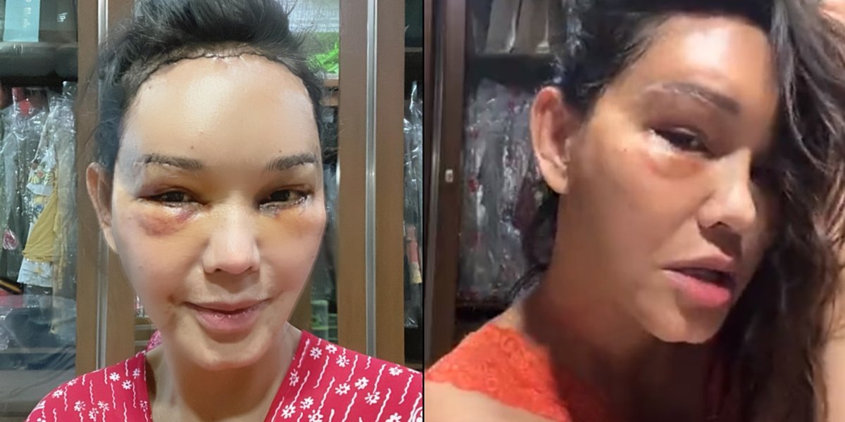 Makes Netizens Worried, 8 Pictures of Bunda Corla Enjoying Dancing After Undergoing Plastic Surgery Worth Rp1.5 Billion: Stitches Might Tear Later