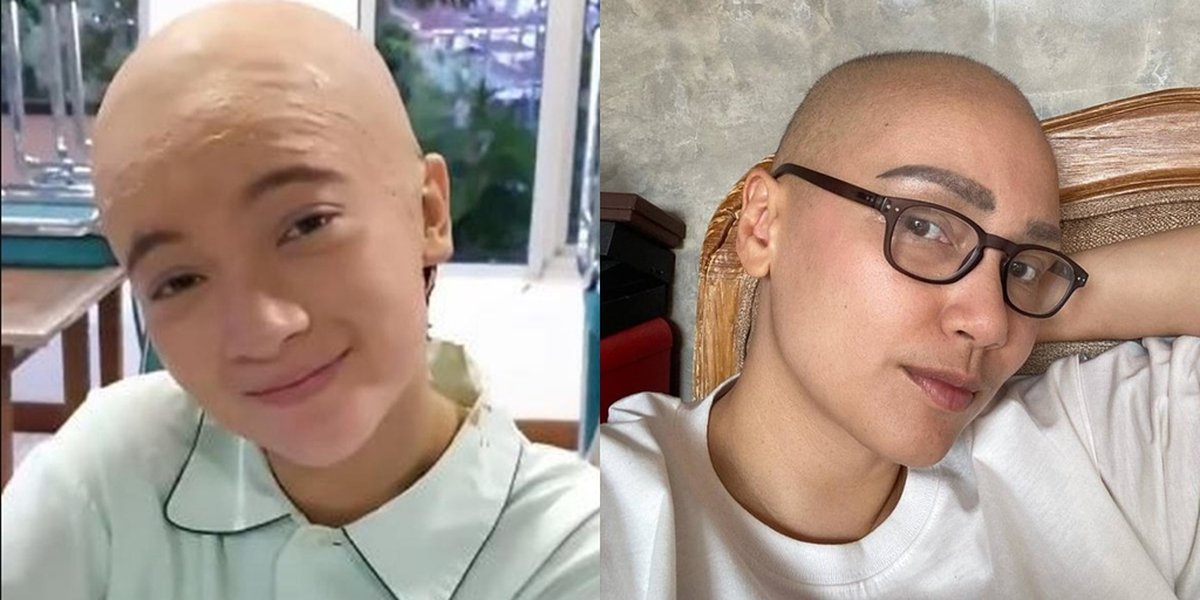 Row of Female Artists Who Have Appeared Bald, Playing the Role of a Girl with Cancer - Some Have Undergone Chemotherapy