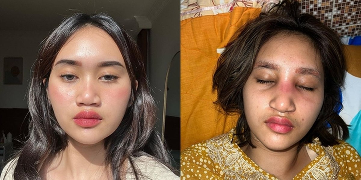 Criticism Because of Plastic Surgery, Portrait of Permesta Dhyaz, Farida Nurhan's Child, Suffers Implant Infection - Swollen and Red Nose