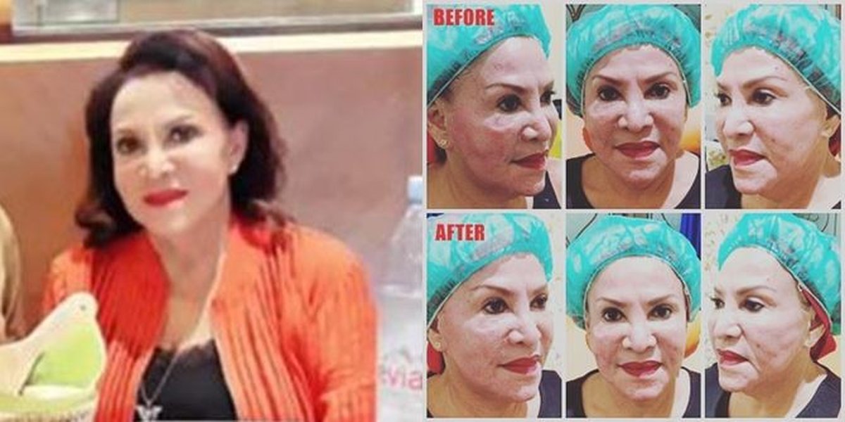 Latest Photos of Mpok Atiek After Dozens of Silicone Removal Surgeries, Stunning at 64 Years Old