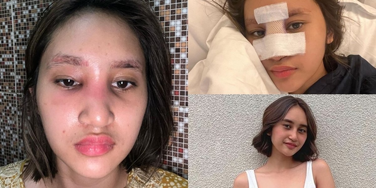 Infection Due to Plastic Surgery, 16 Chronological Portraits of Permesta Dhyaz, Farida Nurhan's Child, Experiencing Swelling in the Nose - Now the Implant is Removed