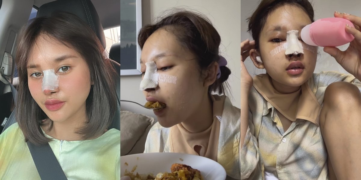 Frequently Bullied, 10 Recent Photos of Permesta Dhyaz, Farida Nurhan's Child, Who Just Had Another Nose Surgery - Not Giving Up Despite Previous Failure and Infection