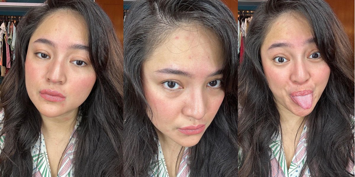 Marshanda Shows off Red and Pimply Face, Vicky Prasetyo's Cheesy Comment Becomes the Highlight