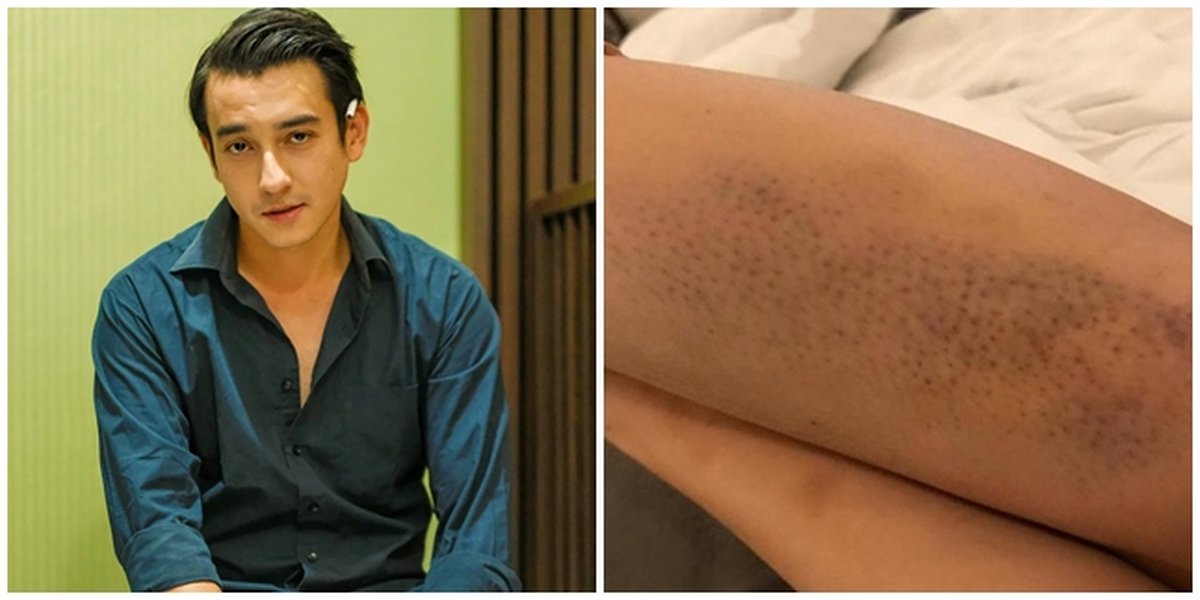 Sad! Here are 5 Photos as Evidence of Domestic Violence by Aliff Ali to Aska Ongi, Bruised and Bleeding