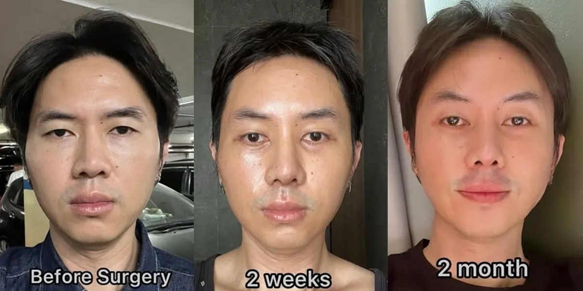 7 Photos of Rafael Tan's Face Transformation After Nose Surgery, Swelling Has Subsided After 2 Months