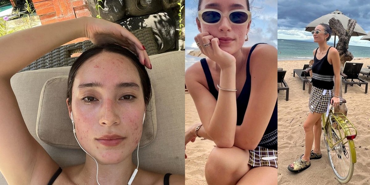 Portrait of Tatjana Saphira Bareface Shows Acne Scars, Receives Lots of Support