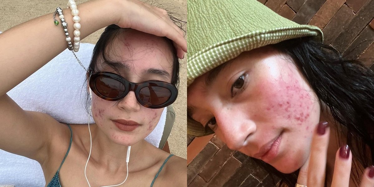 Portrait of Tatjana Saphira Confidently Showing Bare Face with Acne, Admits Needing 10 Years to Heal