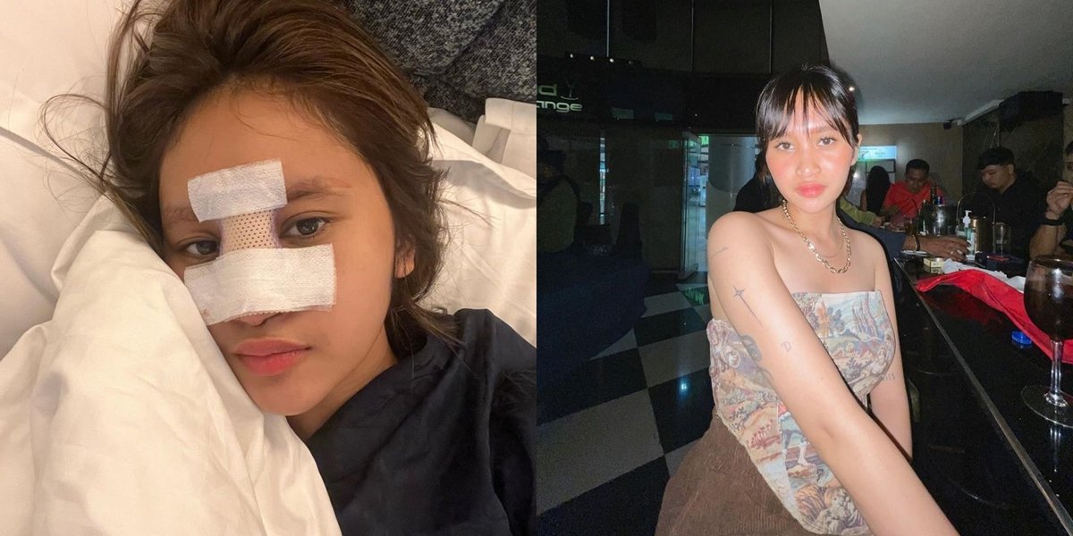 Latest Portraits of Permesta Dhyaz, Farida Nurhan's Child, After Natural Nose Surgery Infection, Netizens Mock the Strange Shape of His Face