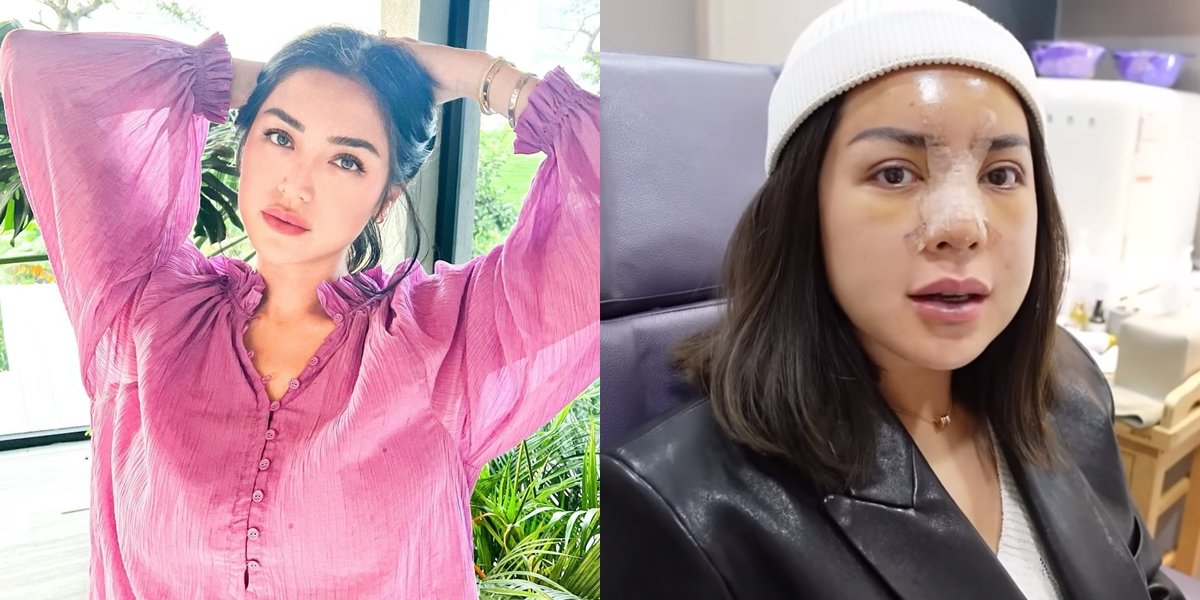 Unable to Breathe Normally, Latest Condition of Jessica Iskandar After Nose Surgery - Weird Face with Chubby Cheeks Like a Cute Woman