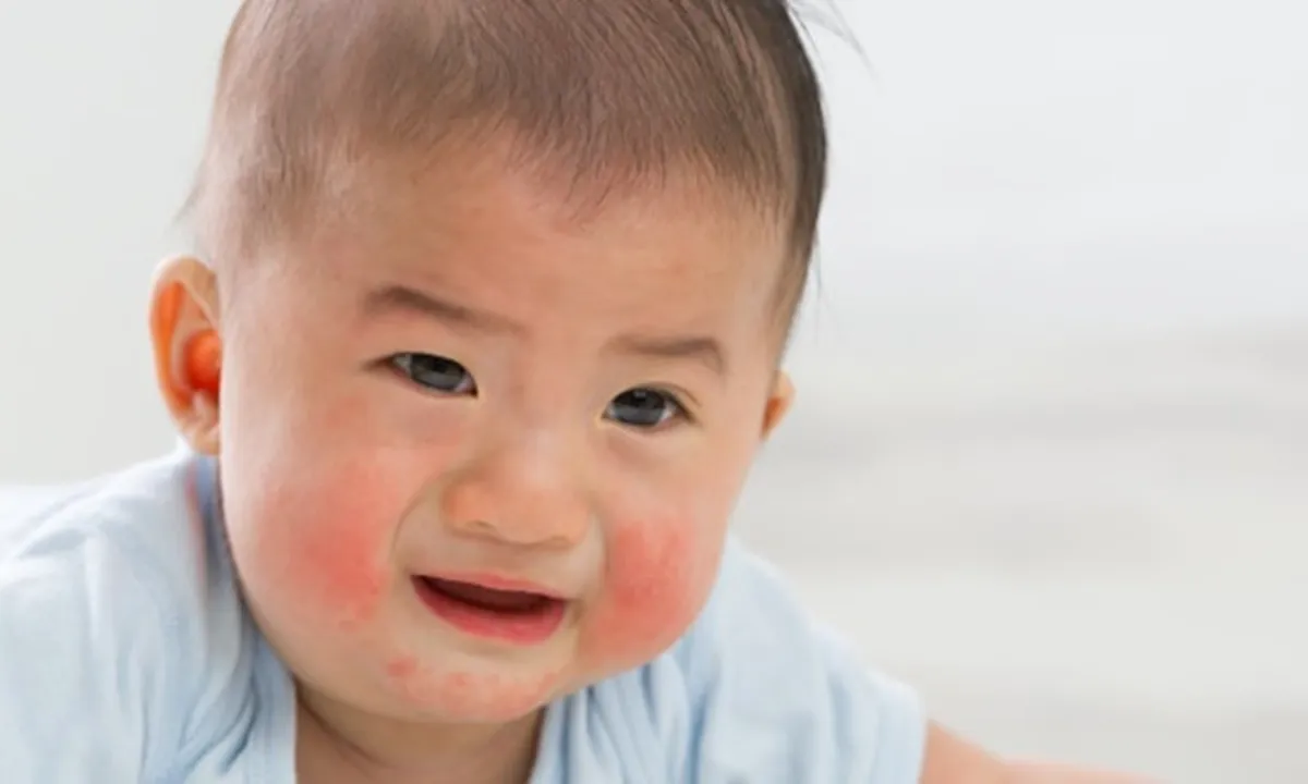 6 Gejala Alergi Susu Sapi Pada Anak, Orangtua Wajib Tahu