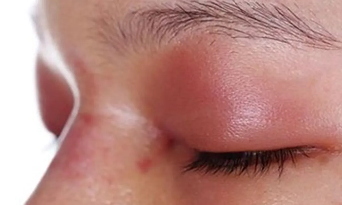 7 Cara Mengatasi Mata Bengkak dengan Mudah dan Cepat, Bisa Pakai Bahan Alami