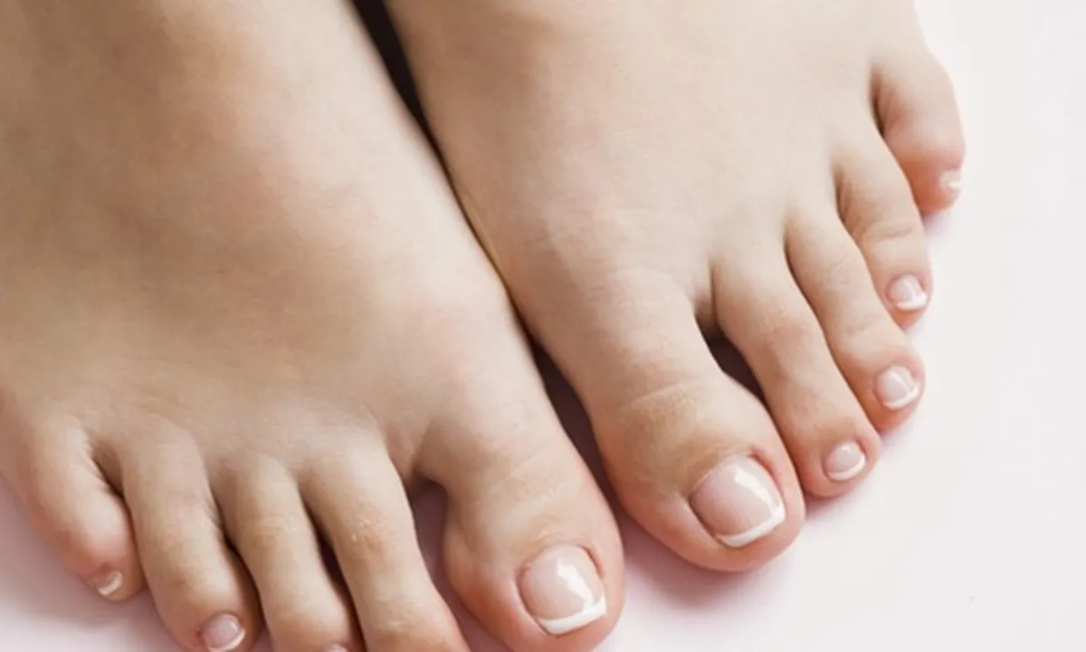 7 Cara Mengobati Kutu Air di Kaki Secara Alami, Salah Satunya dengan Bawang Putih.