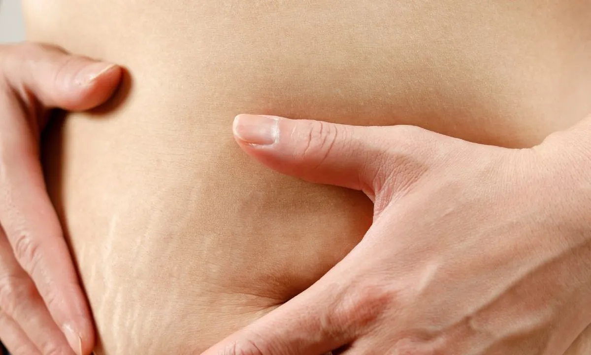 7 Metode Ampuh dan Praktis untuk Mengatasi Stretch Marks!
