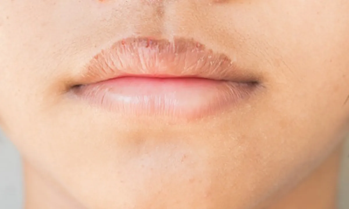 7 Penyebab Bibir Kering dan Pecah-Pecah, Hati-Hati Bisa Disebabkan Kebiasaan Sepele