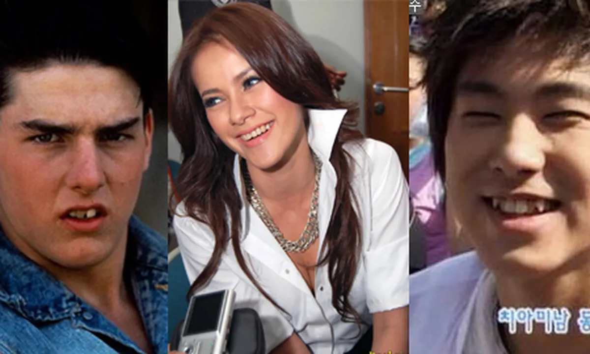 7 Selebritis Ini Melakukan Operasi Gigi