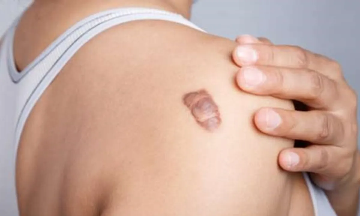9 Cara Menghilangkan Keloid Secara Medis dan Alami, Pilih Mana?