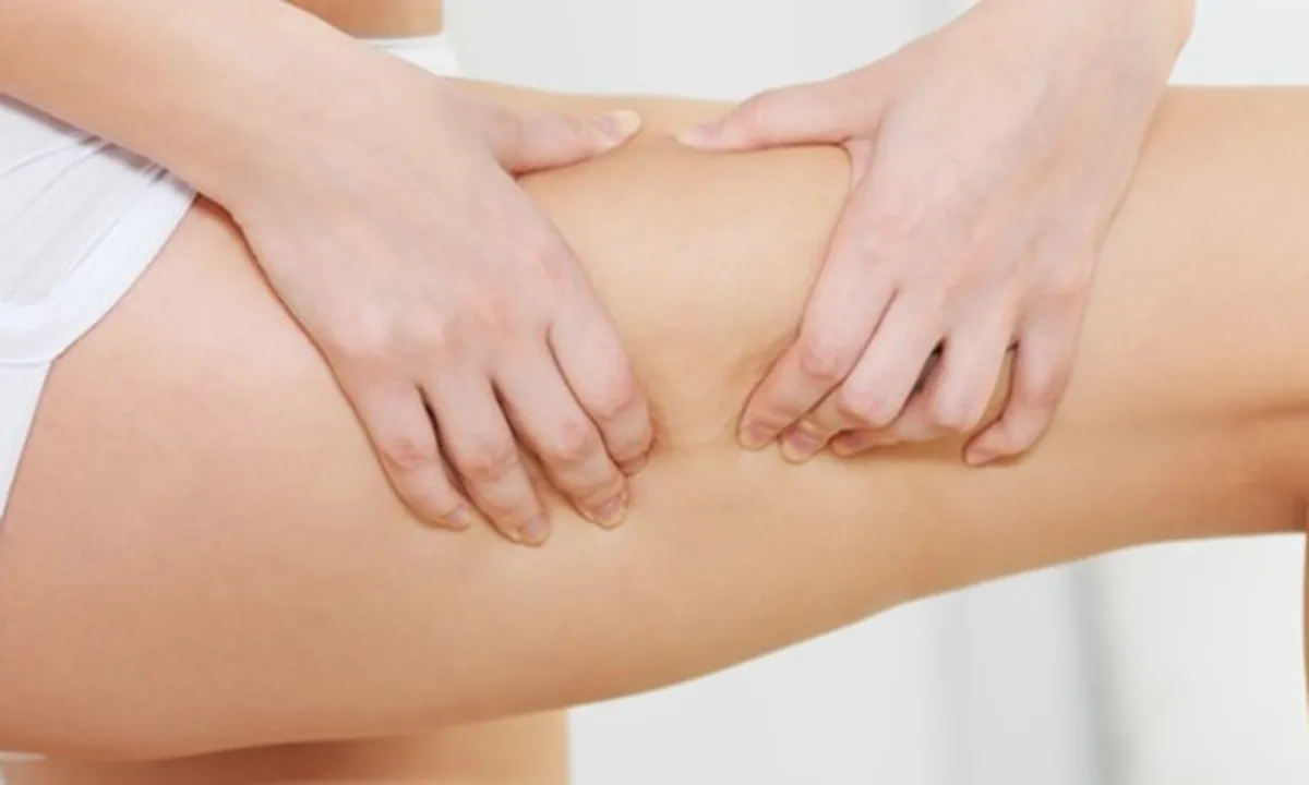 9 Penyebab Selulit yang Sering Terjadi, Waspadai Kebiasaan Tertentu