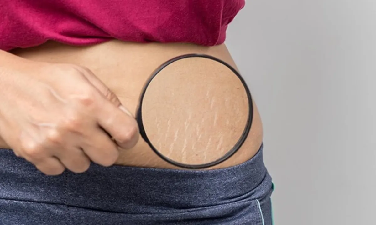 9 Penyebab Stretch Mark yang Umum di Tubuh dan Cara Mengatasinya