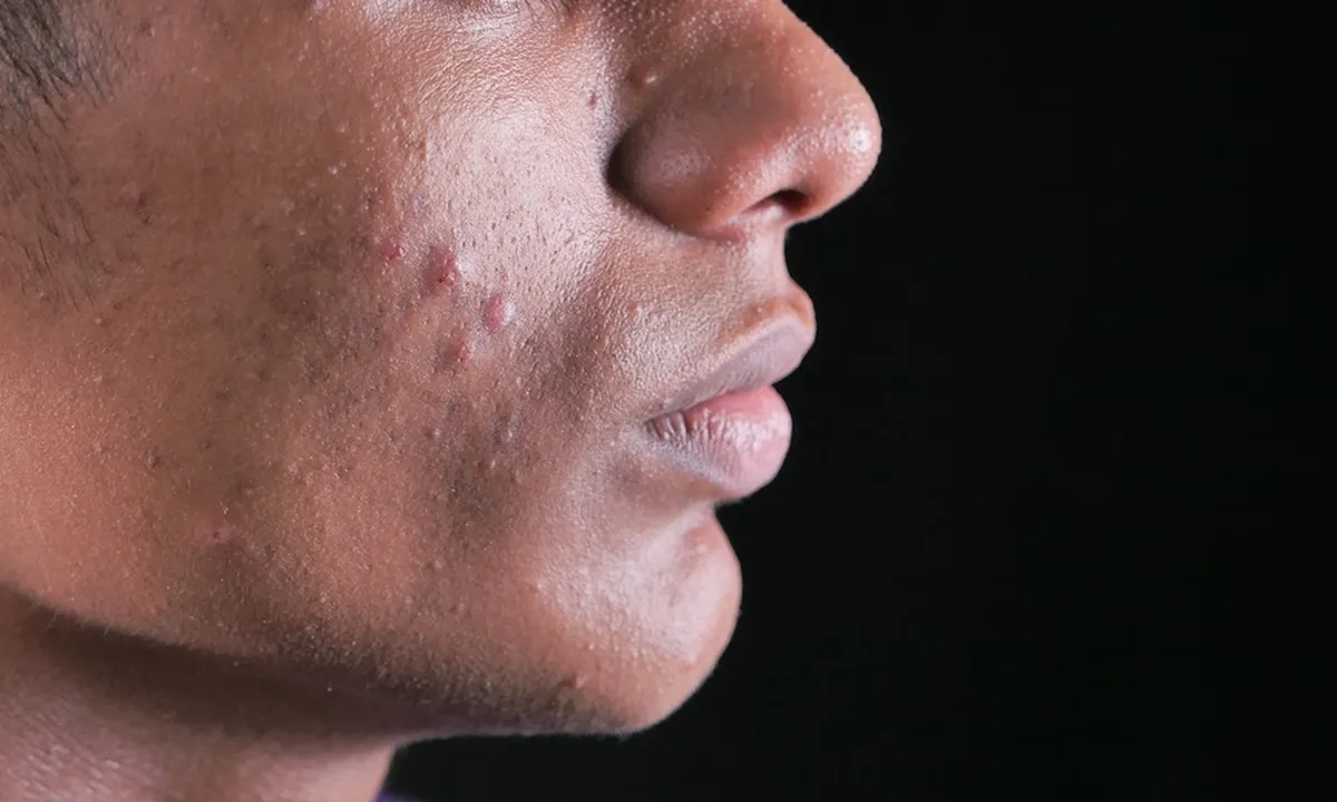 Arti Jerawat di Hidung Menurut Primbon, Ketahui Pula Gejala Timbulnya