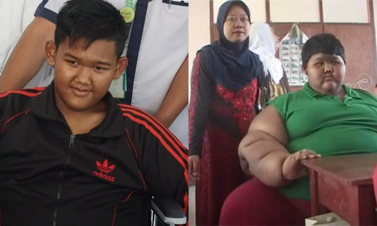 Berhasil Turunkan Berat 103 Kg, Arya Permana Jalani Operasi Pembuangan Kulit